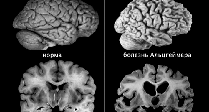 Диагностика болезни Альцгеймера
