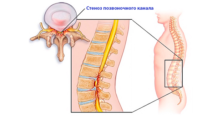 Симптомы стеноза позвоночного канала