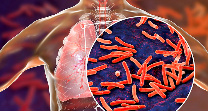 Факторы риска туберкулеза