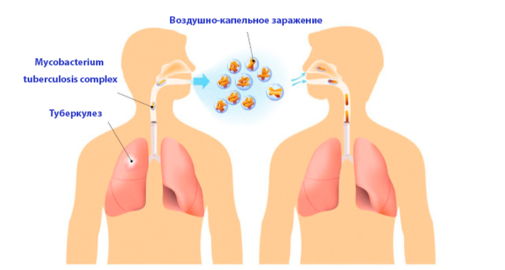 Что вызывает туберкулез