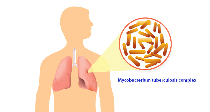 Типы туберкулеза