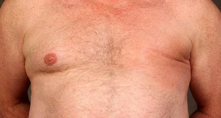 Факторы риска рака груди у мужчин