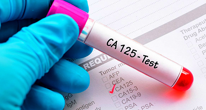 Анализ крови CA 125 при раке яичников