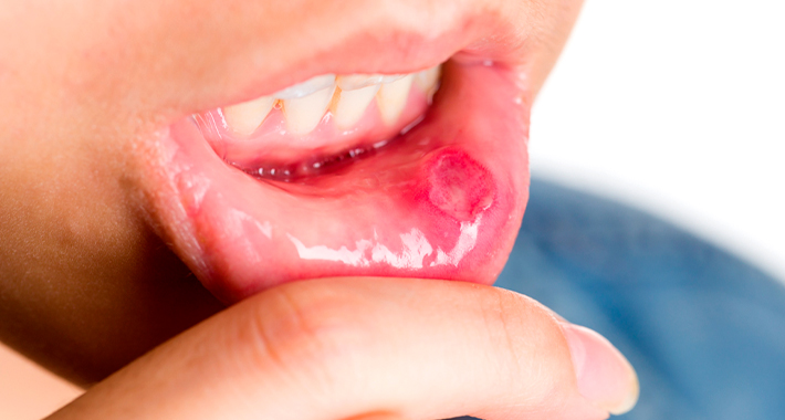 Причина появления язв во рту во время лечения рака