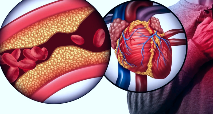 Почему у большинства людей случаются сердечные приступы