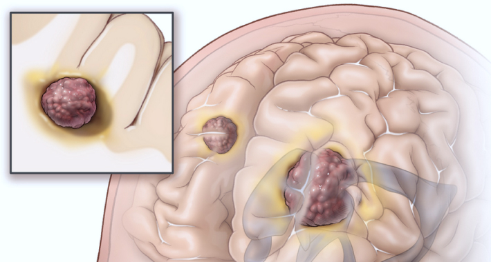 Симптомы и причины возникновения метастазов в головной мозг