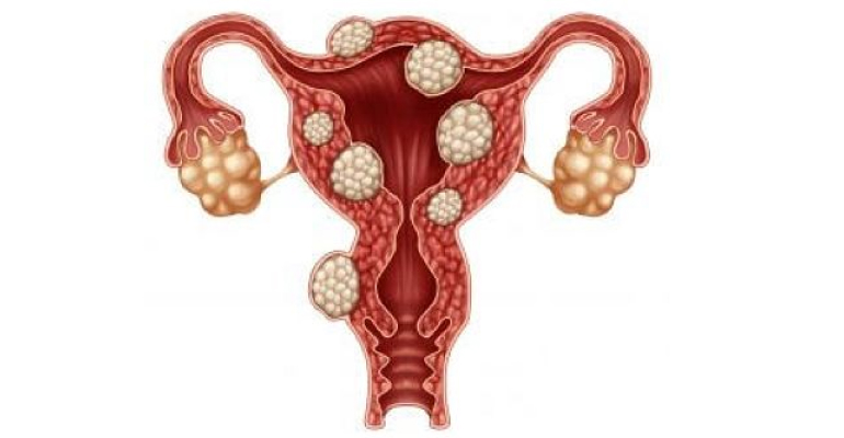 ≡ Лечение фибромиомы без операции: основные методы | Клиника 