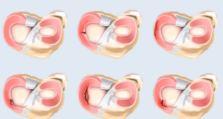 Код по мкб повреждение мениска