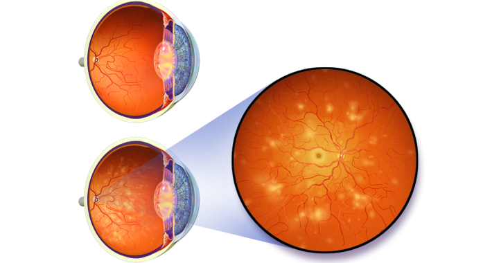 Что такое диабетическая ретинопатия?