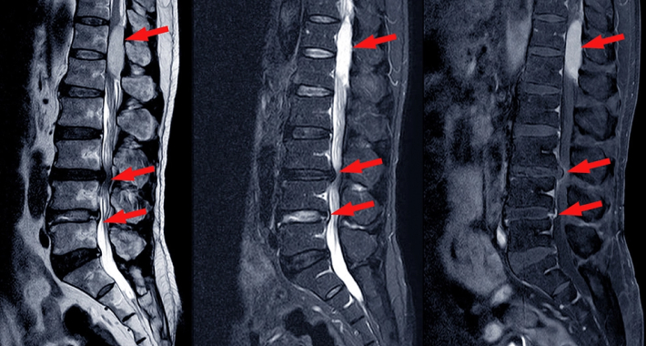 Что такое спинальный стеноз? Виды, симптомы и диагностика